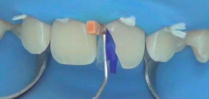 Direct Adhesive Restorative Options in the Anterior Area | Dr Riccardo Ammannato