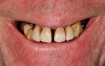A-Z in Restorative Implant Dentistry (Case 1) - Maxillary Full Arch PFM Bridge