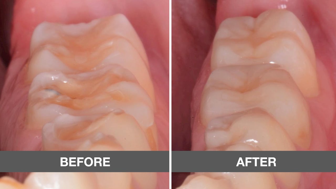 CLINICAL VIDEO Index Adhesive Technique Part 01 gIDE Dental Institute