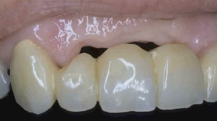 Soft Tissue Management During Implant Procedures