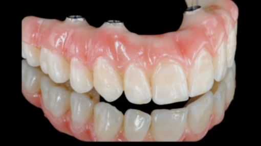 The All on 4 Concept: Diagnosis to Delivery Part 1 - Diagnosis and Treatment Pl