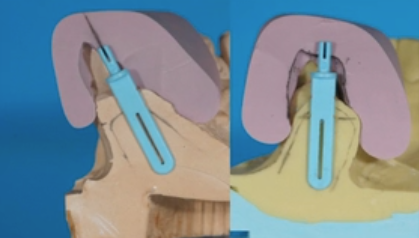 The 3D Click Guide - A New Direction for Model-Based Guided Implant Placement