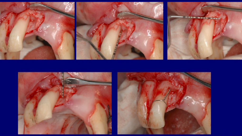 Understanding Growth Factors in Dentistry: Emdogain, PRF GEM21 and BMP2