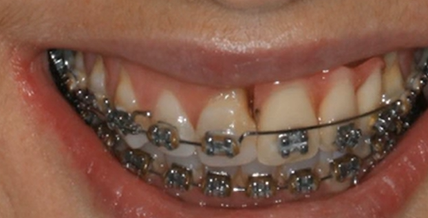 Benefits of the TR-Membrane in Vertical Ridge Augmentation | Dr  da Silva