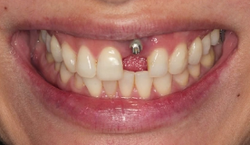 CLINICAL VIDEO Sub-Epithelial Connective Tissue Harvest to Boost Gingiv