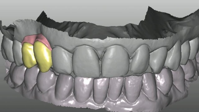 CLINICAL VIDEO Implant placement with digital planning, hard and soft tissue gra