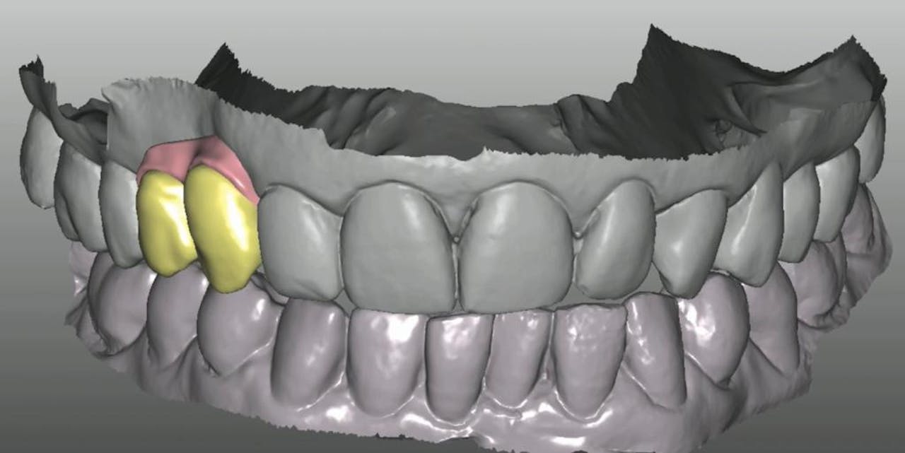 CLINICAL VIDEO Implant placement with digital planning, hard and soft