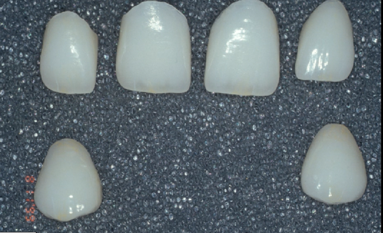 Provisionalization of Indirect Restorations