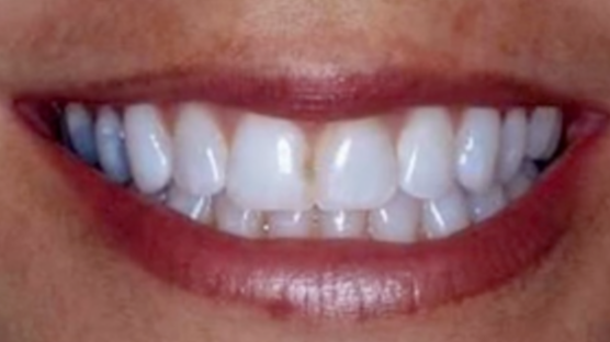 Direct Anterior Composite Restorations