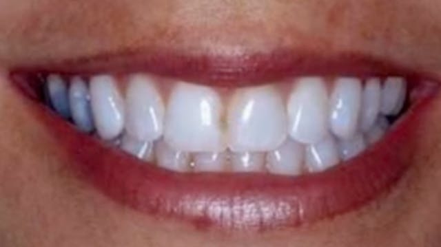 Direct Anterior Composite Restorations