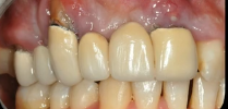 Introduction to Prosthetic Rehabilitation on Natural Teeth
