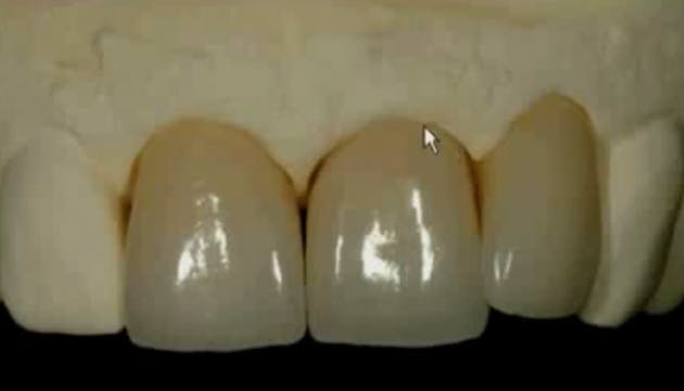 Anterior Esthetic Implant Treatment