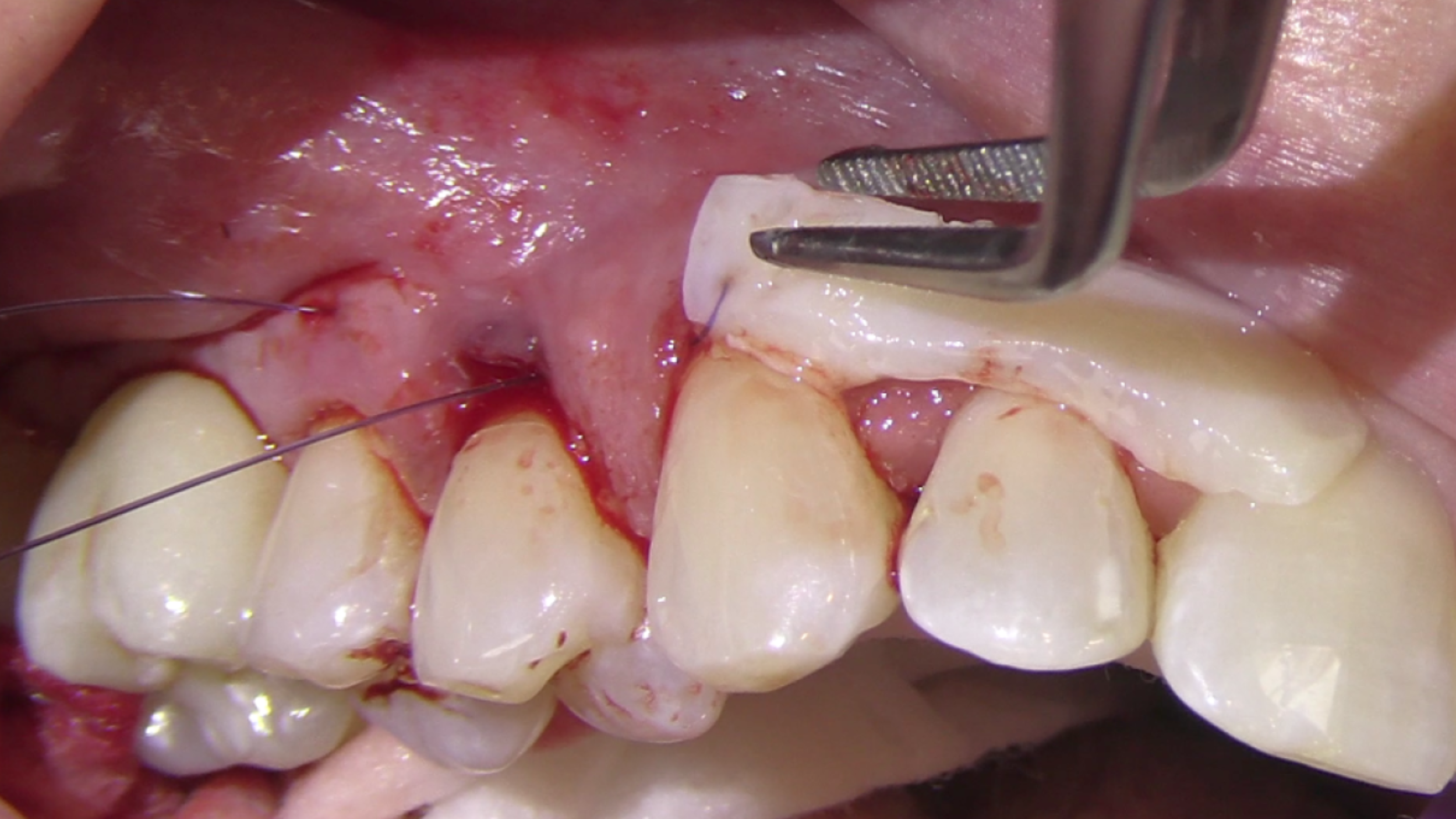 CLINICAL VIDEO Root Coverage of 2 Upper Premolars with Connective Tissue, Emdoga