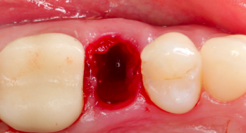[PLAYLIST] Extraction Socket – Preservation/Grafting; Immediate vs Delayed