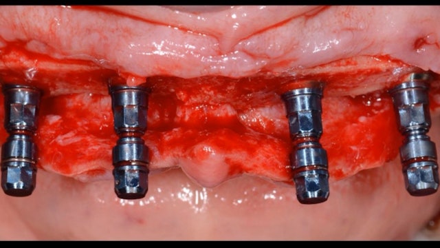 Implant-Retained Dentures - Evidence, Planning, and Execution