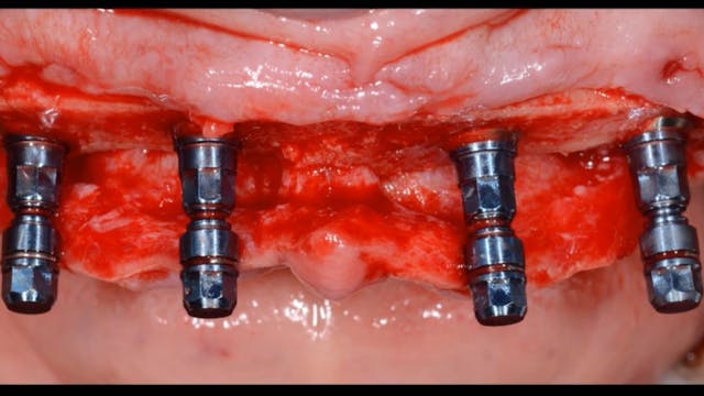 Implant-Retained Dentures - Evidence,...