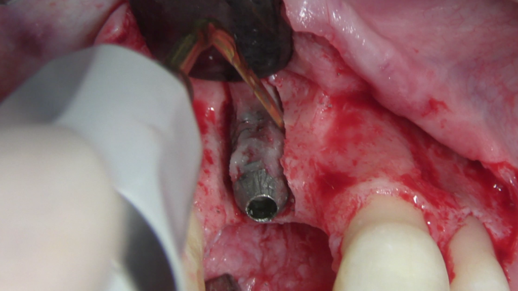 CLINICAL VIDEO Removal of an Integrated Bicon Implant using Piezosurgery with a 