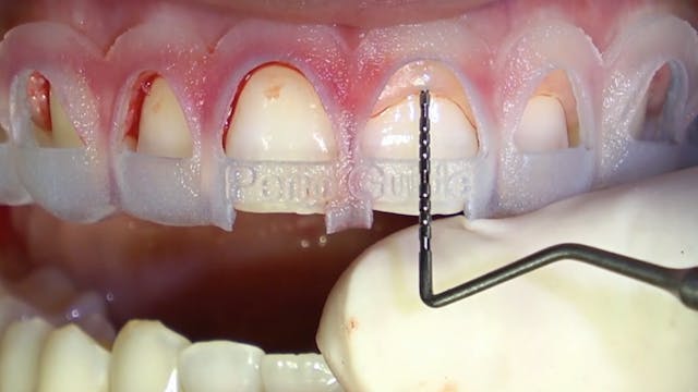 Gummy Smile Correction - From Analog ...