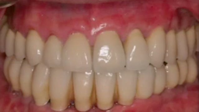 Advanced Implant Treatment Planning: ...