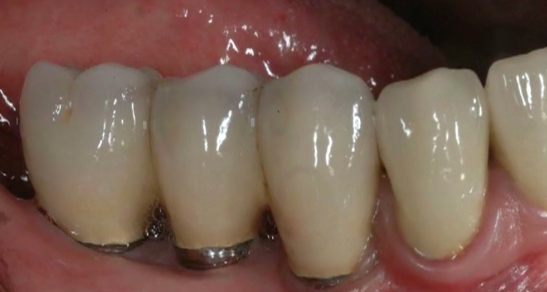 CLINICAL VIDEO Vertical Ridge Augmentation (Part 1): 1-stage Vertical Ridge Augm