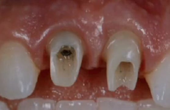 Anterior Implant Positioning for Idea...