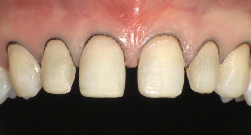 CLINICAL VIDEO-Previsualization in Esthetic Dentistry - A Useful System for Trul