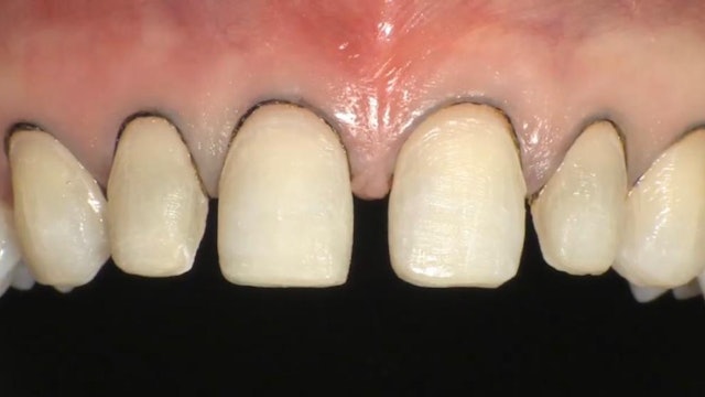 CLINICAL VIDEO-Previsualization in Esthetic Dentistry - A Useful System for Trul