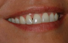 Tissue Engineering for Hard and Soft Tissue Regeneration: Clinical and Applied