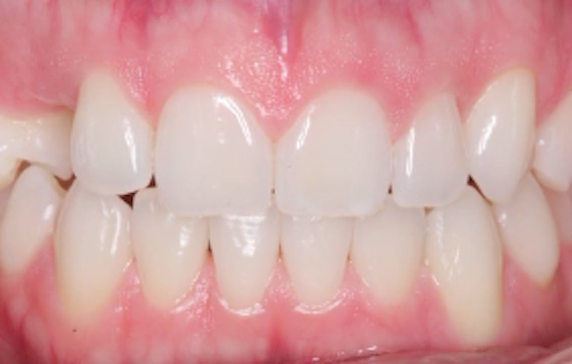 CLINICAL VIDEO Anterior Implant Placement with Immediate Temporization