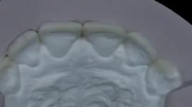 Veneer Restorations - Essential Steps for Esthetic Success