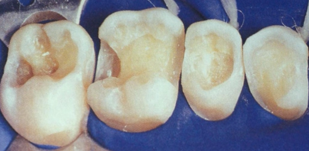 Indirect Posterior Restorations