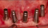 A-Z in Restorative Implant Dentistry (Part 2b) - Impression Techniques
