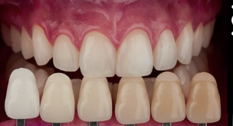 Color in Dentistry - Communication with the Lab