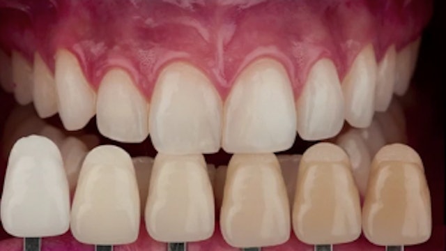 Color in Dentistry - Communication with the Lab