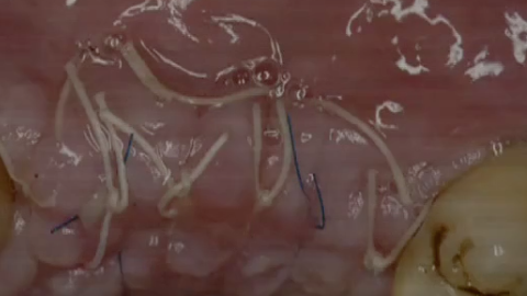 CLINICAL VIDEO - Simultaneous Vertical Hard and Soft Tissue Augmentation