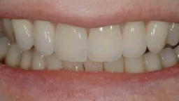 Achieving Ultimate Aesthetics with Implants in the Aesthetic Zone: Lecture I