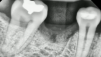 CLINICAL VIDEO Socket Preservation after a Lower Molar Extraction using an