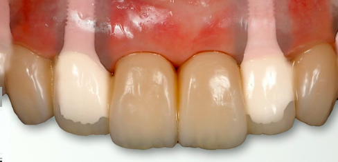 New Approaches for Implant-Esthetic & Periodontal Surgery