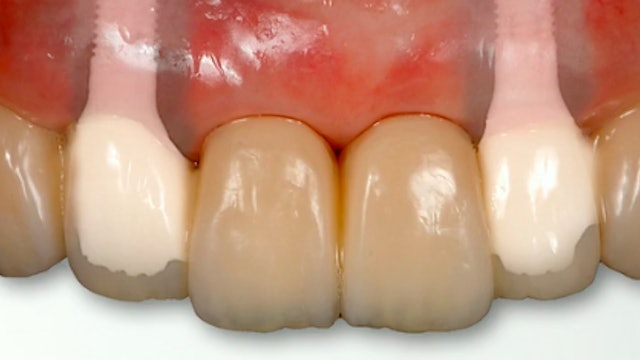 New Approaches for Implant-Esthetic & Periodontal Surgery
