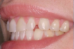 Esthetic Periodontal Surgery to Enhance Restorative Results