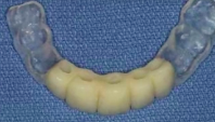 Immediate vs. Late Implantation Replacing Multiple Adjacent Missing Teeth in th
