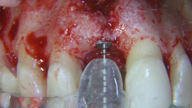 CLINICAL VIDEO Esthetic Implant Place...
