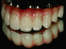 Treatment of Mandibular Edentulism and the Terminal Dentition