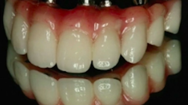 Treatment of Mandibular Edentulism and the Terminal Dentition