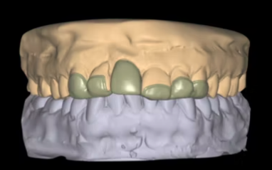 CLINICAL VIDEO Immediate Tooth Replacement with Simultaneous Socket and Soft Tis
