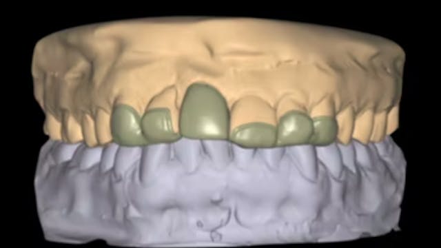 CLINICAL VIDEO Immediate Tooth Replac...