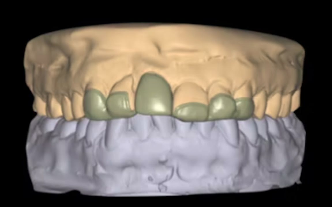 CLINICAL VIDEO Immediate Tooth Replacement with Simultaneous Socket and