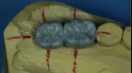 Posterior Implant Placement from a surgical perspective