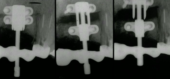 CLINICAL VIDEO Vertical Ridge Augmentation (Part 3): Vertical Distraction Os