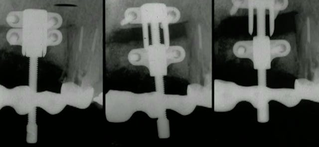 CLINICAL VIDEO Vertical Ridge Augment...